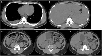 Case Report: Near-Fatal Intestinal Hemorrhage and Acute Acalculous Cholecystitis due to Vi-Negative and Fluoroquinolone-Insensitive Salmonella enterica Serovar Typhi Infection: A Rare Entity